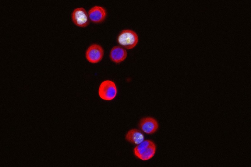 Breast tumor cells
