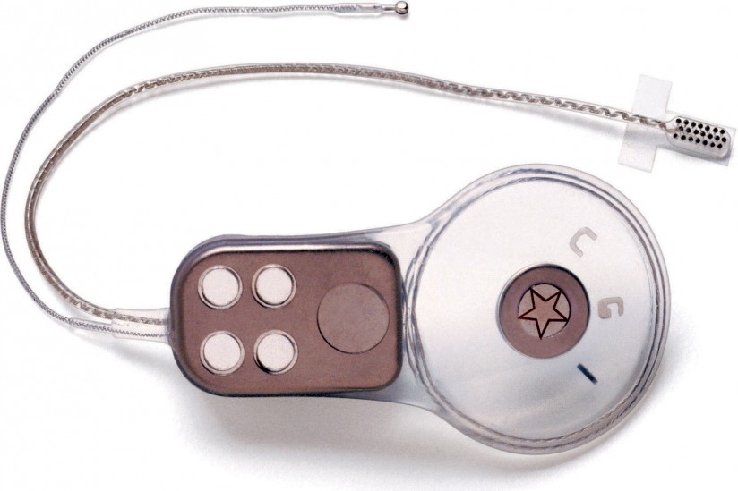 Auditory brainstem implant