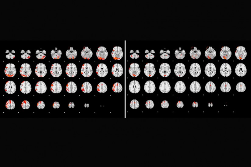 brain scan