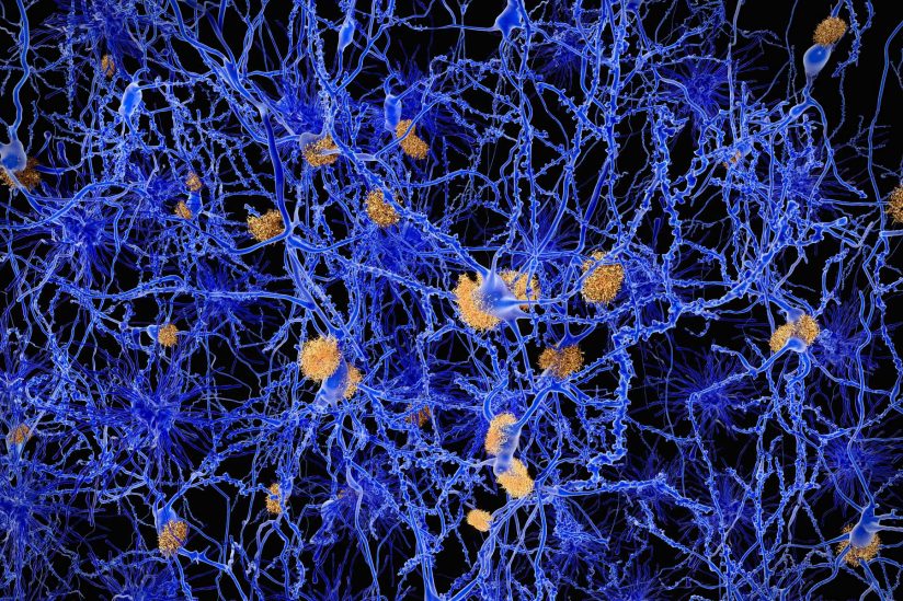 illustration of Amyloid Plaques wit