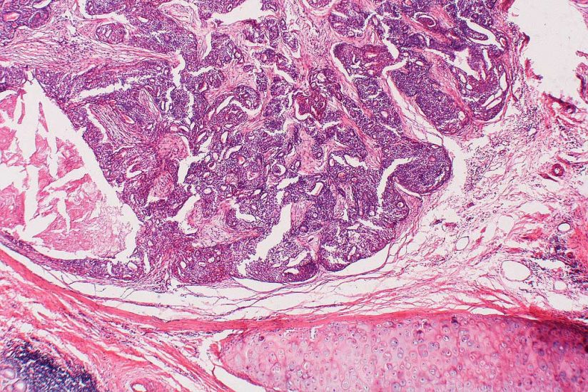 microscopic view of a tumor