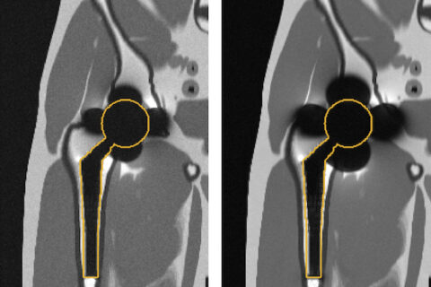 Imaging of hip replacement